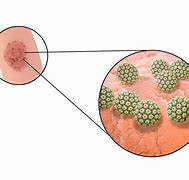 Image result for Human Papillomavirus Infection in Men