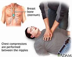 Image result for Chest Recoil CPR Animation