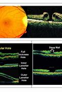 Image result for Macular Pseudohole Oct