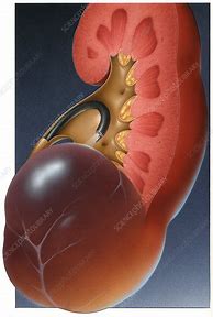 Image result for Complex Renal Cyst