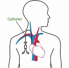 Image result for Central Venous Catheter Dialysis