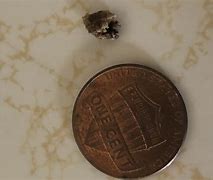 Image result for Picture of 5Mm Kidney Stone