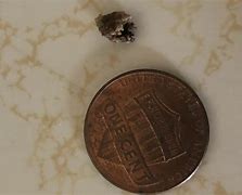 Image result for Picture of 5Mm Kidney Stone