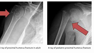 Image result for humeral