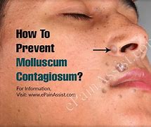 Image result for Molluscum Contagiosum Toddler Treatment