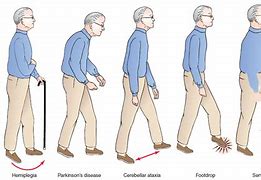 Image result for Gait Dyspraxia