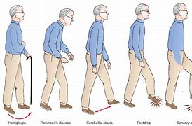 Image result for Apractic Gait