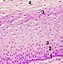 Image result for Genital Human Papillomavirus Stages