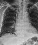 pneumoperitoneum 的图像结果