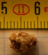 Image result for What Does a 4 mm Kidney Stone Look Like