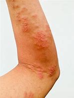 Image result for Shingles On Thigh