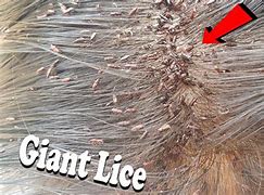 Image result for Biggest Lice Bug Ever