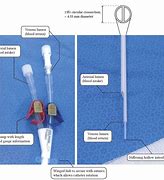 Image result for Trialysis Catheter with Pigtail