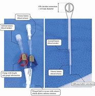 Image result for Dialysis Cath