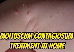 Image result for Musculum Contagiosum Treatment