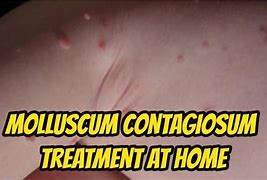 Image result for Molluscum Contagiosum Beetlejuice Treatment