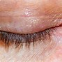 Image result for Macular Hole Vision
