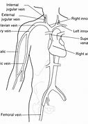 Image result for Central Venous Pressure Catheter