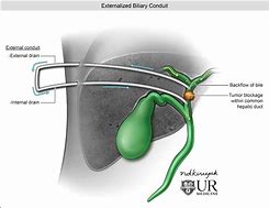Image result for Biliary Drain Stent