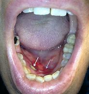 Image result for Pedunculated Oral Lesion
