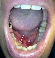 Image result for Pedunculated Oral Lesion
