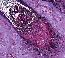 Image result for Molluscum Contagiosum On Dark Skin