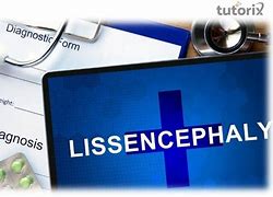 Image result for Lissencephaly