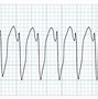 Image result for 3 Beats SVT EKG