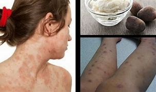 Image result for Ecthyma Cured Scar