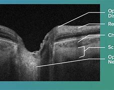 Image result for Oct Scan Optic Nerve