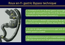 Image result for Rue En Y Gastric Bypass