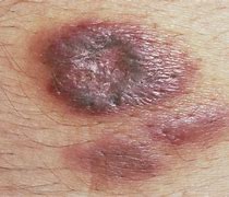 Image result for Sarcoma Di Kaposi