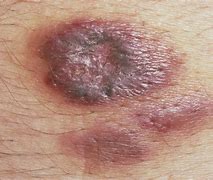 Image result for Sarcoma Pictures