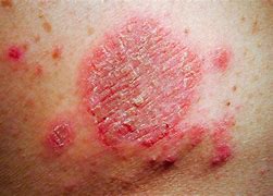 Image result for Eczema Scabs
