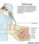 Image result for cystoskopia
