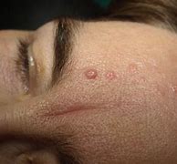 Image result for Sebaceous Gland Hyperplasia