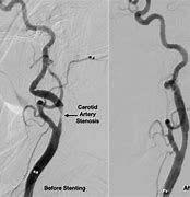 Image result for Carotid Artery Stent Ultrasound