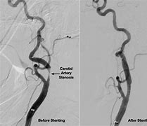 Image result for Carotid Artery Stent Procedure
