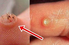 Image result for Professional Wart Removal