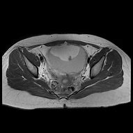 Image result for Ovarian Dermoid MRI Radiology