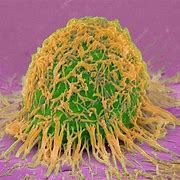 Image result for Cervical Cancer Cells