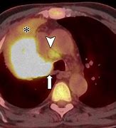 Image result for Heart and Lung Cancer