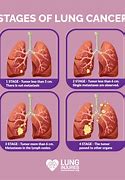Image result for Lung Cancer Disease