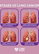Image result for 2 Cm Tumor Size Of