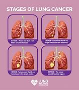 Image result for Types of Lung Cancer Chest Pain