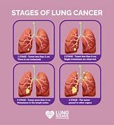 Image result for Lung Cancer Pictures