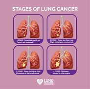 Image result for Lung Cancer Back Pain