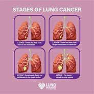Image result for Lung Cancer Signs