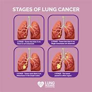Image result for Lung Cancer Postmortm