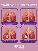 Image result for 9 Cm Tumor in Lung
